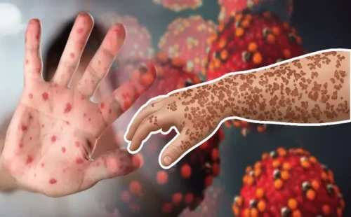 শিশুদের হামের মতো আরেক রোগ রুবেলা